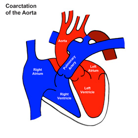 Coarctation of the Aorta (CoA)