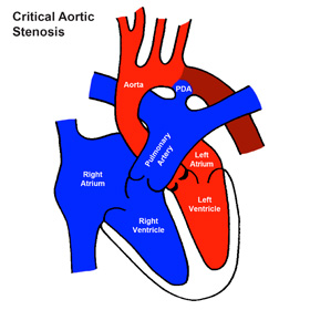 Critical Aortic Stenosis (Critical AS)
