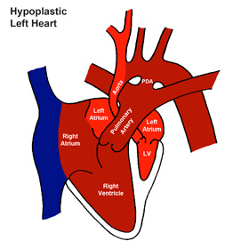 Hypoplastic Heart Syndrome (HLHS)