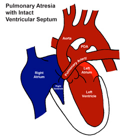Pulmonary Atresia with Intact Ventricular Septum (PA/IVS)