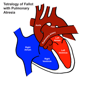 Tetralogy of Fallot with Pulmonary Atresia(ToF/PA)