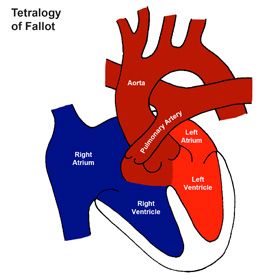 Tetralogy of Fallot (ToF)