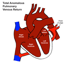 Total Anomalous Pulmonary Venous Return (TAPVR)